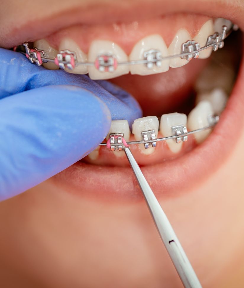 Professional Braces Treatments at Boston Medical Care