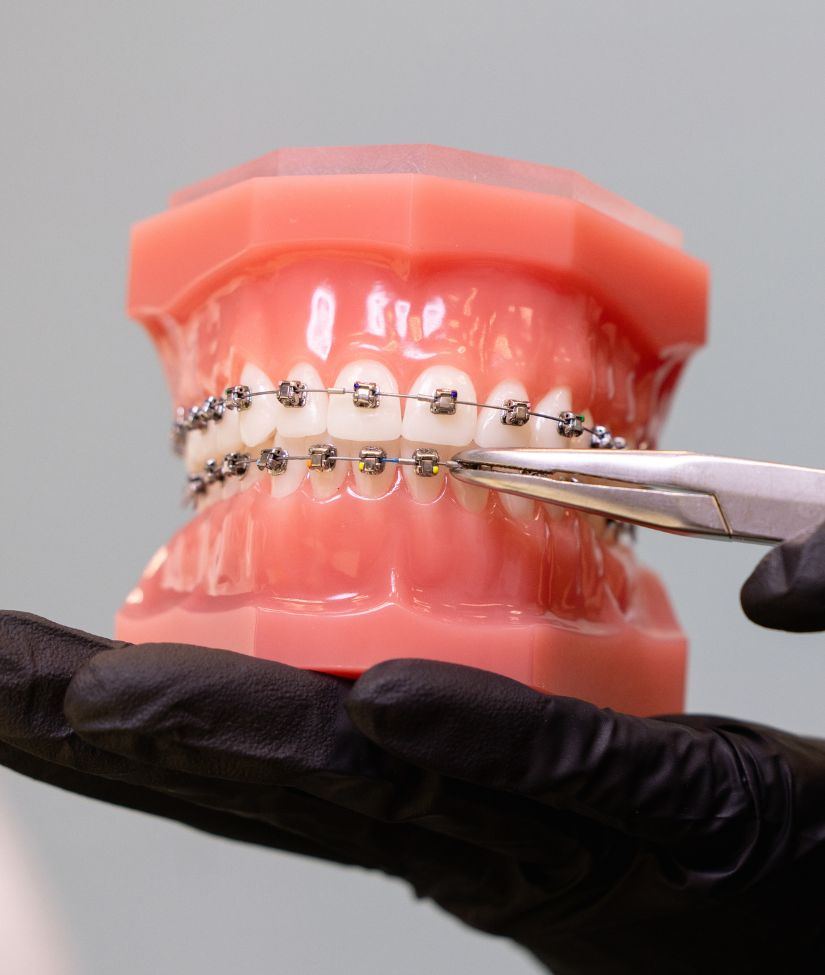 Who Can Benefit from Braces​