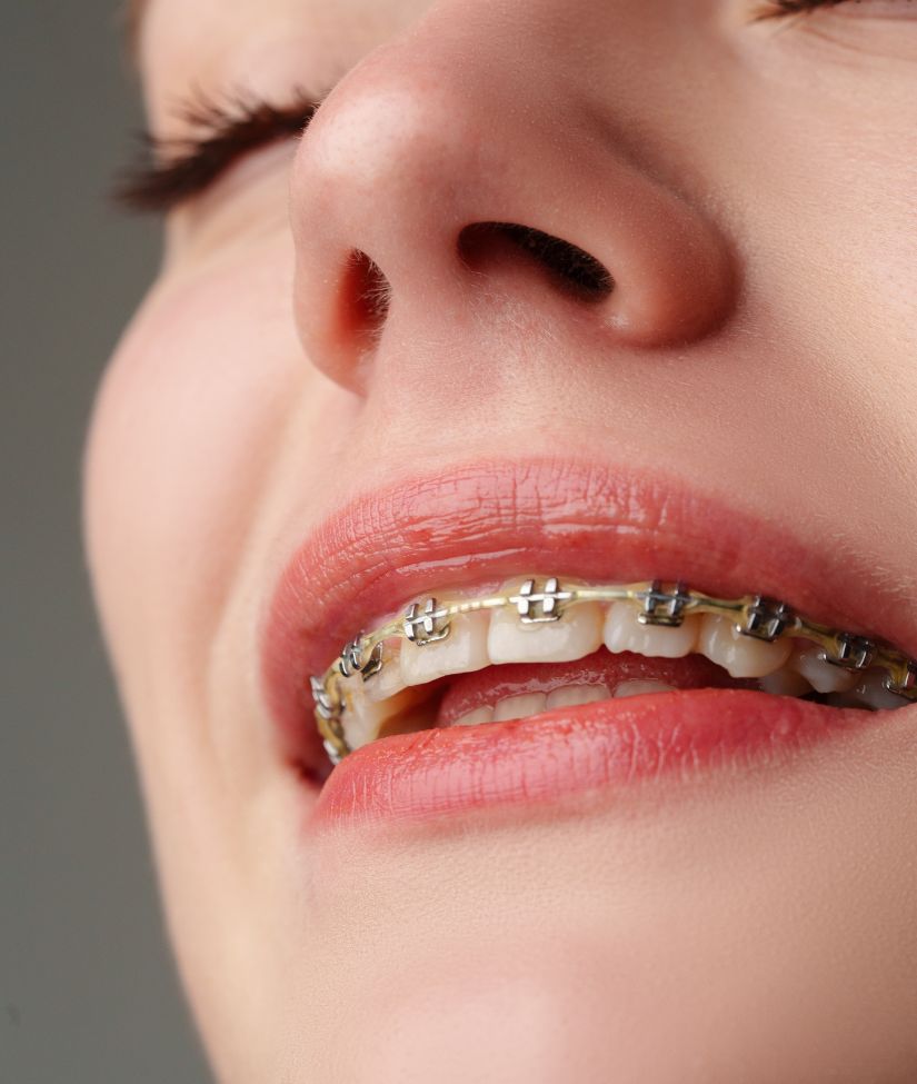 Braces Price and Cost in Qatar​