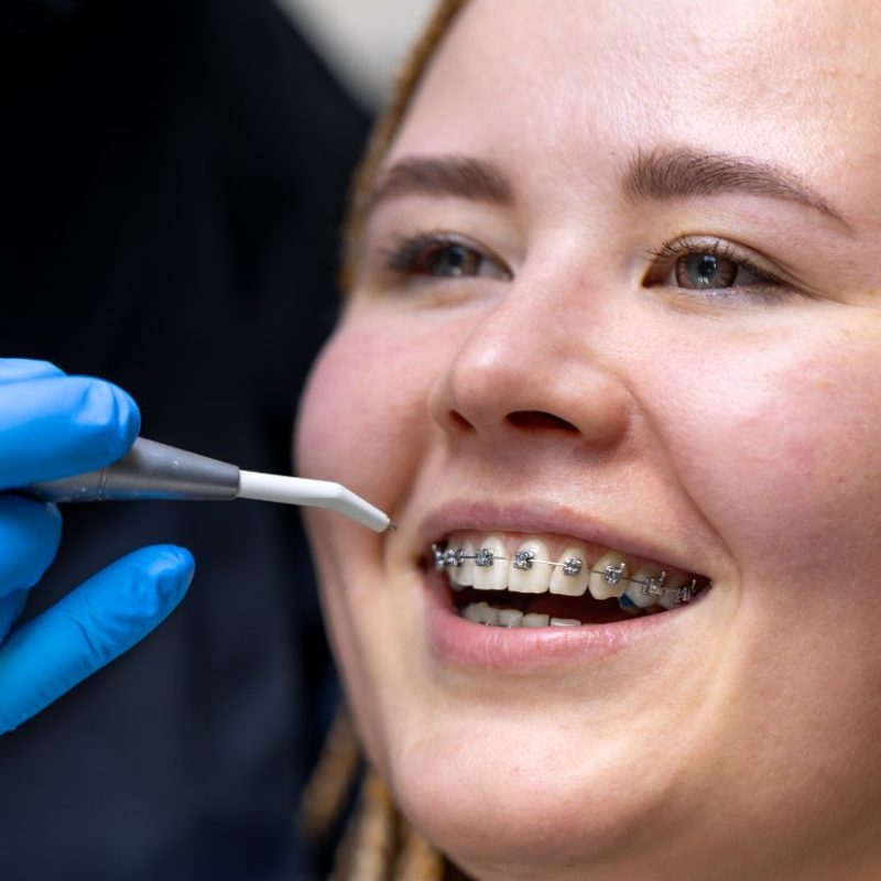 How Braces Work to Straighten Teeth